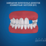 sna_Byugel_na_klammerakh_pri_vklyuchennom_defekte