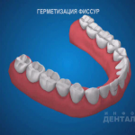sna_Germetizatsia_fissur