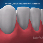 sna_Gingivit