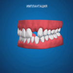 sna_Implantatsia