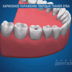 sna_Karies