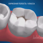 sna_Karioznaya_polost_1_klassa