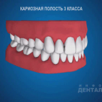 sna_Karioznaya_polost_3_klassa