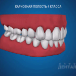 sna_Karioznaya_polost_4_klassa