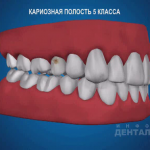 sna_Karioznaya_polost_5_klassa