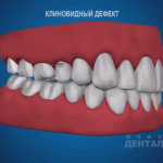 sna_Klinovidny_defekt