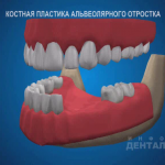 sna_Kostnaya_plastika