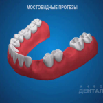 sna_Mostovidnye_protezy