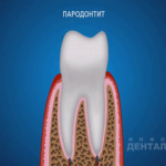sna_Parodontit