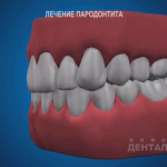 sna_Parodontit_-_lechenie