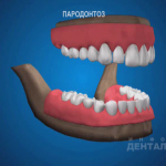 sna_Parodontoz