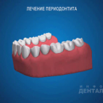 sna_Periodontit_-_lechenie
