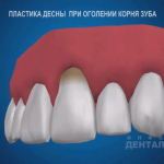 sna_Plastika_retsessii