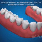 sna_Plombirovanie_kompozitom