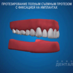 sna_Semnye_protezy_na_implantakh
