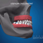 sna_Sinus-lifting