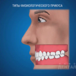 sna_Vidy_prikusa