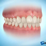 sna_aligners